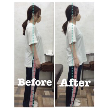 1回の施術で効果を実感！姿勢改善　Before After