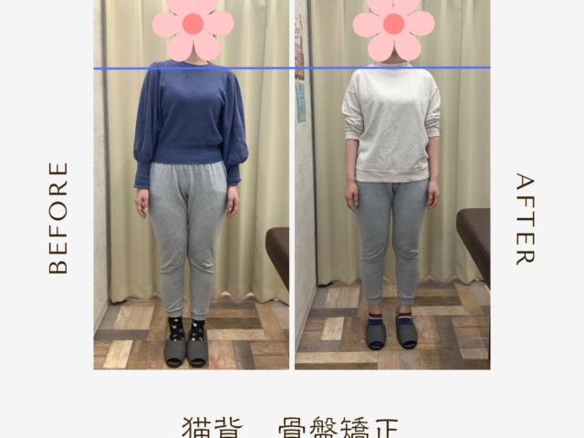 猫背と巻き型の違いとは？